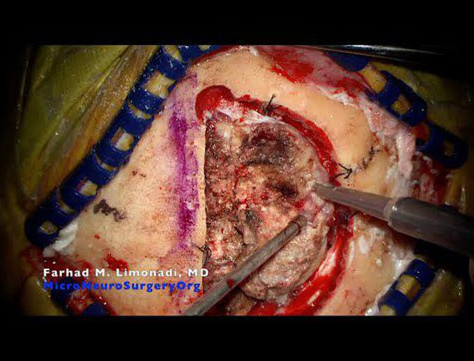 Brain tumor surgery: Surgical removal of brain tumor (meningioma)