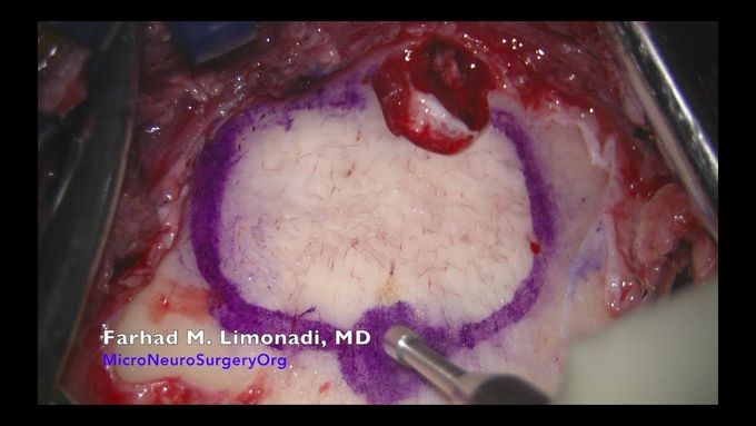 Awake brain surgery for resection of glioblastoma multiforme