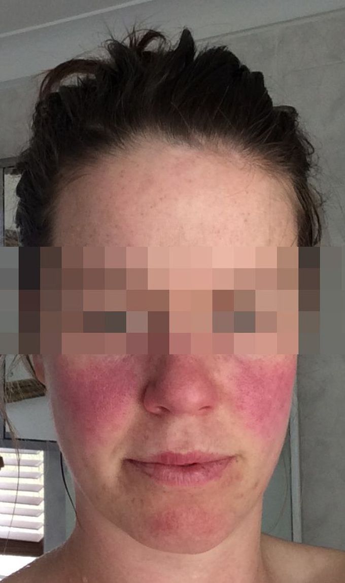 Treatment for Lupus facial rash