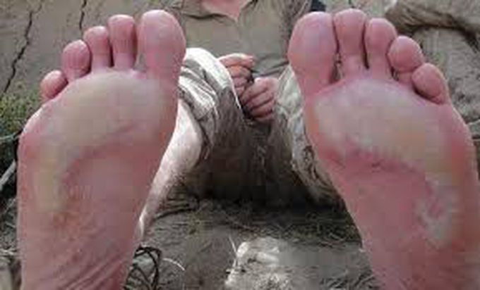 Trench foot