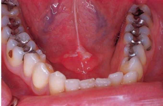 Acute ulcer in floor of mouth