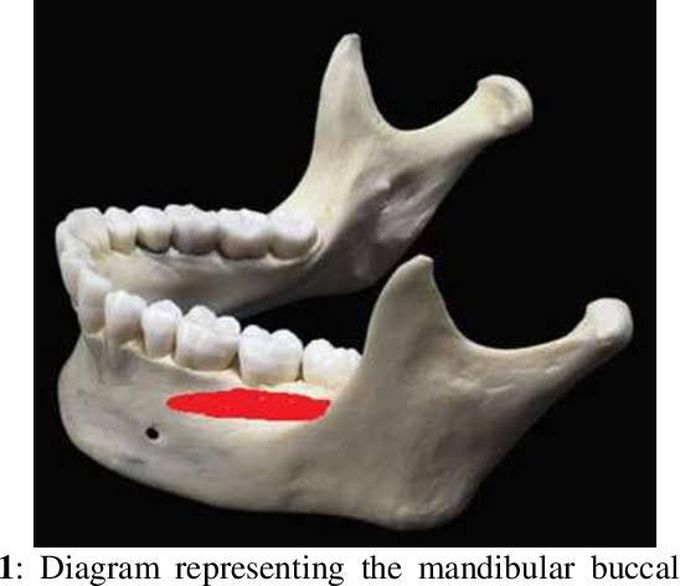 Buccal shelf