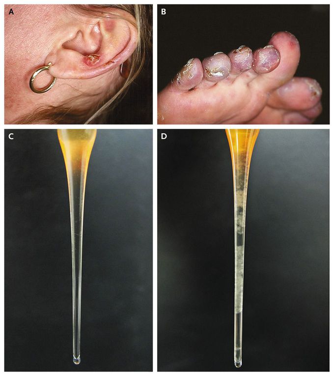 Familial Primary Cryofibrinogenemia