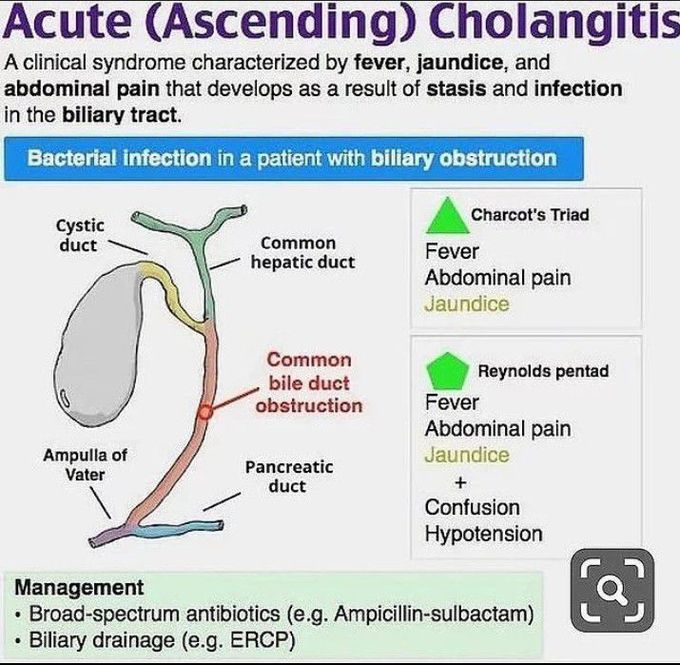 Acute cholangitis