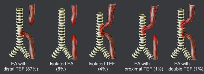 Esophageal Atresia