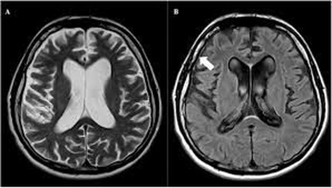 Symptoms of neurosyphilis