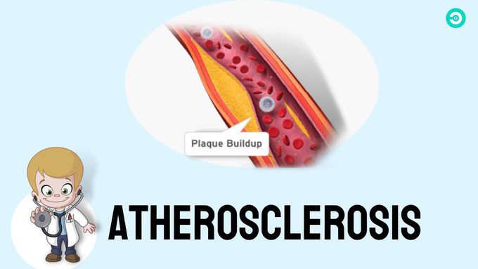 Coronary Atherosclerosis (Arteriosclerotic Heart Disease): Medical animation
