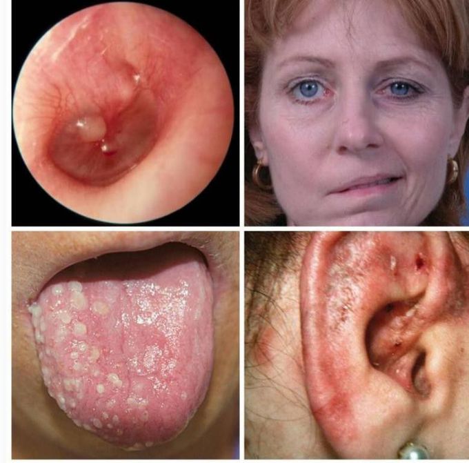 Correlate the 4 pictures to identify the disease..