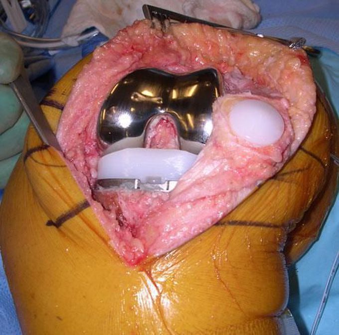 Total knee replacement