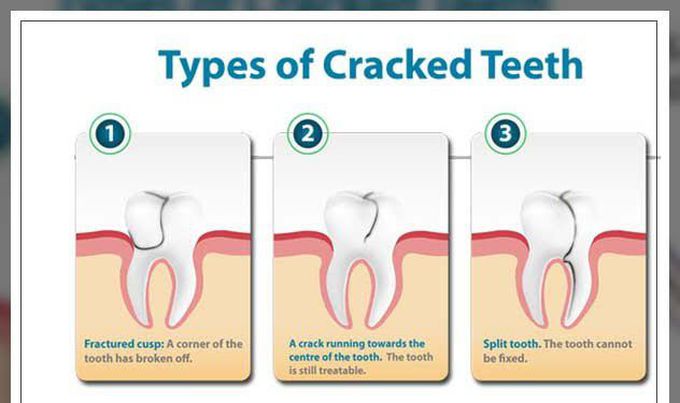 These are the types of  Cracked teeth syndrome