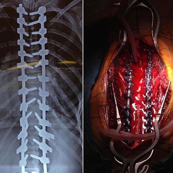 Scoliosis surgery