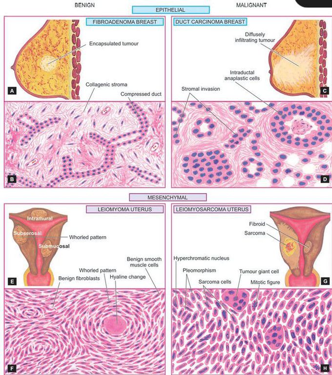 Benign and malignant tumors