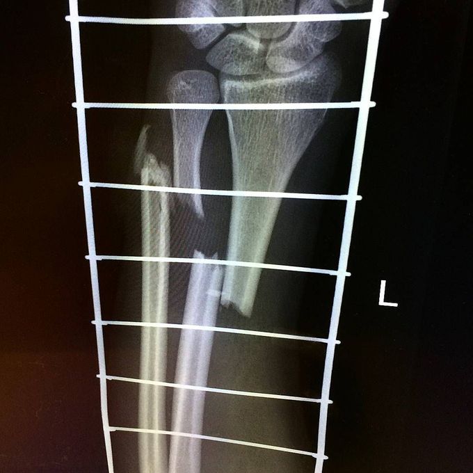 Open fracture of radius and ulna - X-Ray