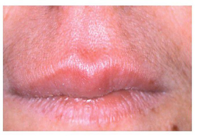 Granulomatous cheilitis