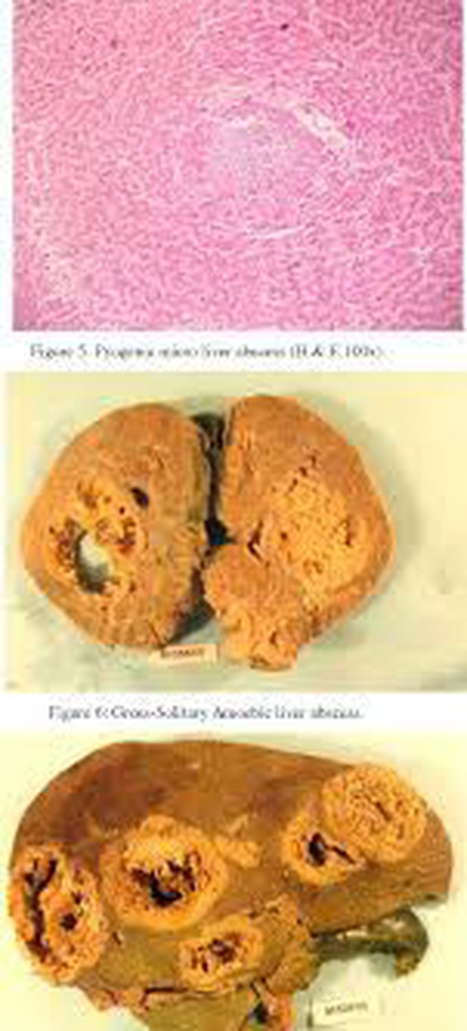 Causes of amebic liver abcess