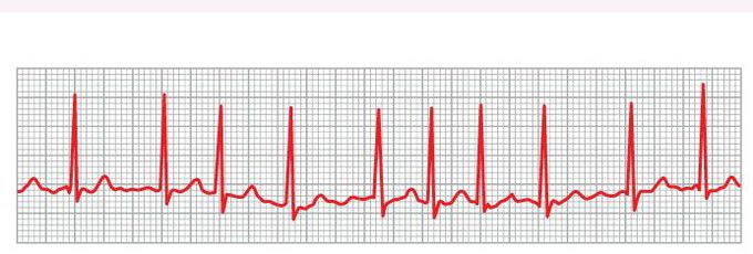 Atrial fibrillation