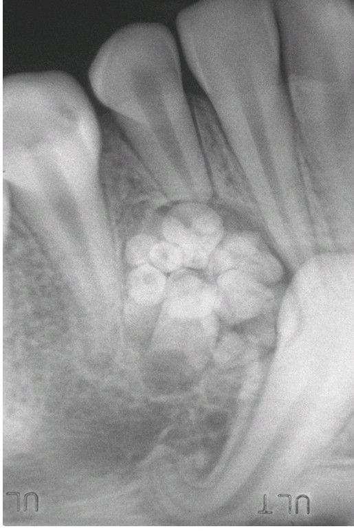 Compound Odontoma MEDizzy