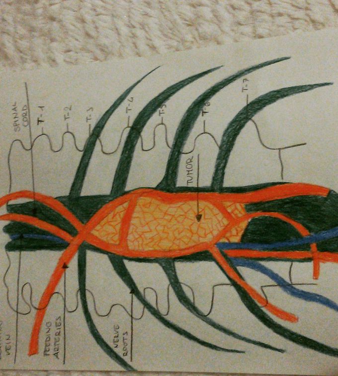 Colonna vertebrale con una massa tumorale 