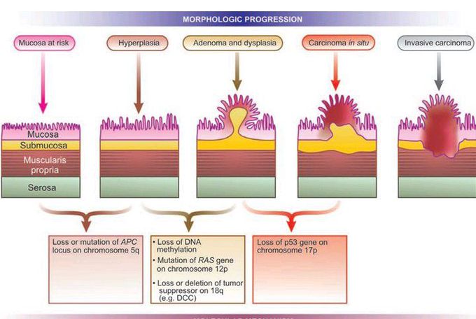 Adenoma-carcinoma sequence