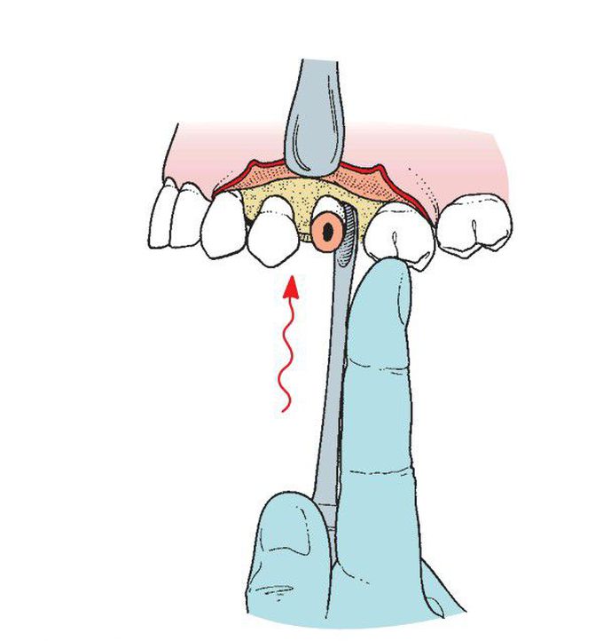 Extraction of fractured root