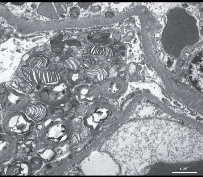 Zebra Bodies in the Kidney