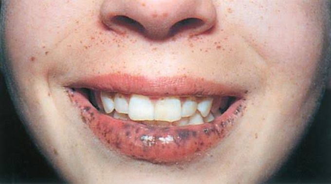 Peutz–Jeghers Syndrome