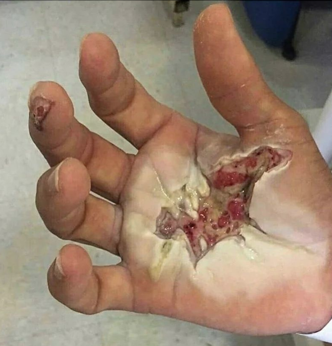 High voltage cable burn to the hand!