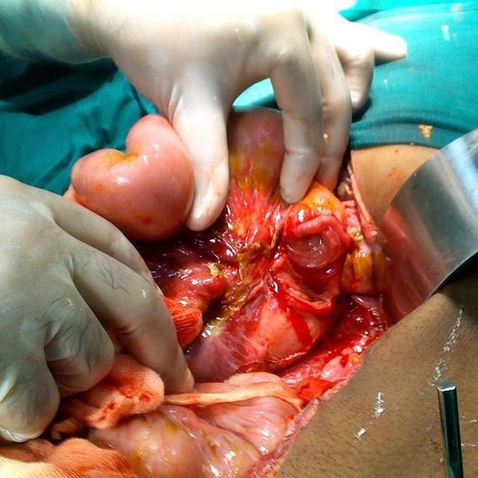 CASE: Blunt trauma to the abdomen with bladder and duodenojejunal flexure rupture. 