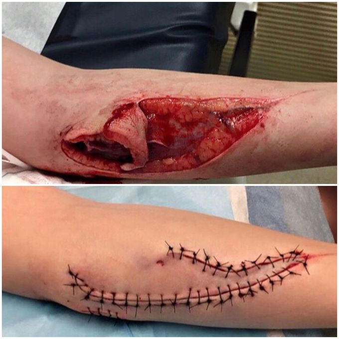 Stiches
