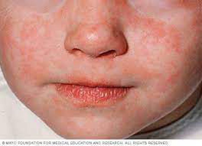 What causes measles?