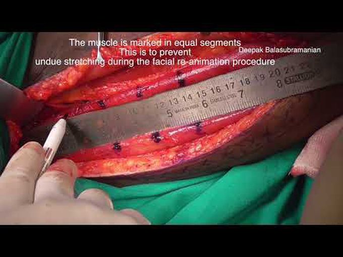 Gracilis free flap