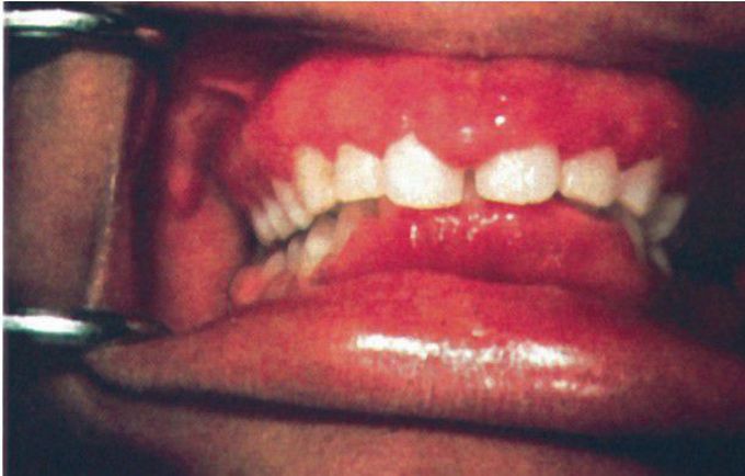 Gingival enlargement