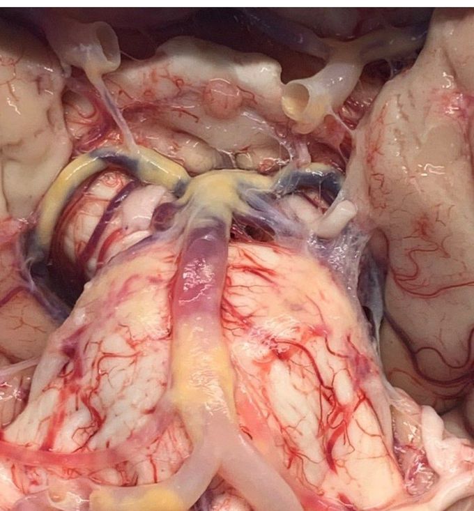 Atherosclerosis in Circle of Willis