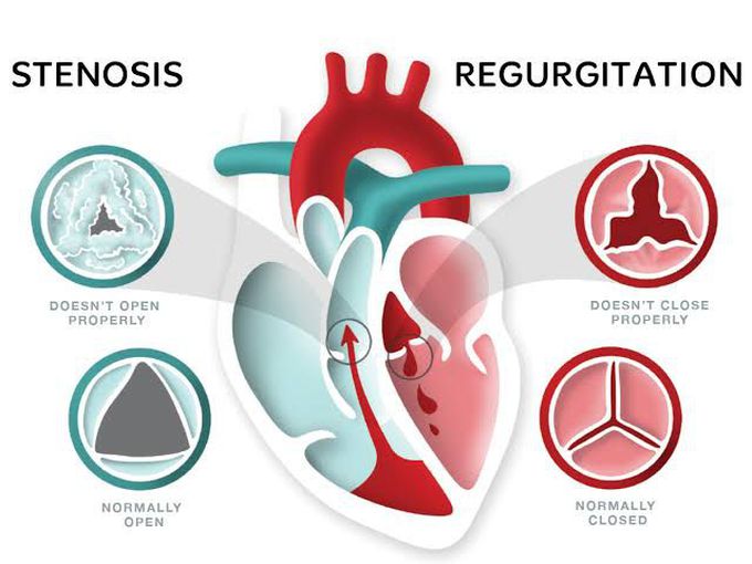 Valvular heart disease