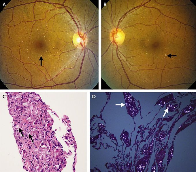 Talc Retinopathy