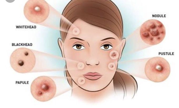 Acne vulgaris