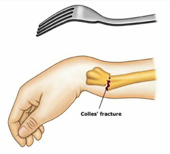 Colles' fracture of the wrist, illustration - Stock Image - C046/2994 -  Science Photo Library