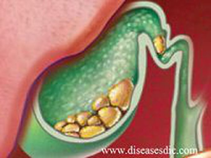 Gallstones: Definition, Causes, Treatment and Management. - Diseases Treatment Dictionary