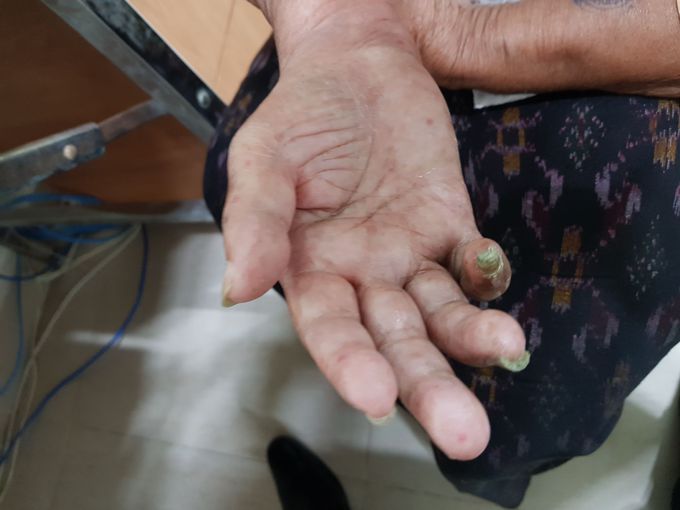 Rt. hand pain with mild swelling and limit of hand movement for 1 year