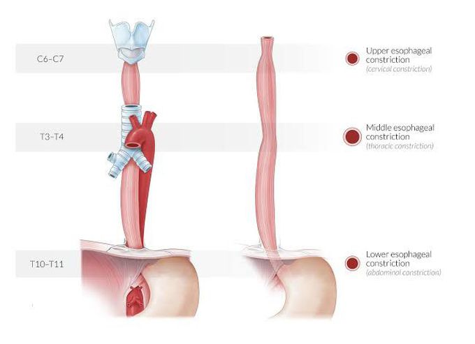 Esophageal Constriction