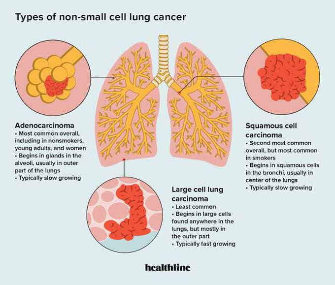 Types of non-small cell lung Carcinoma