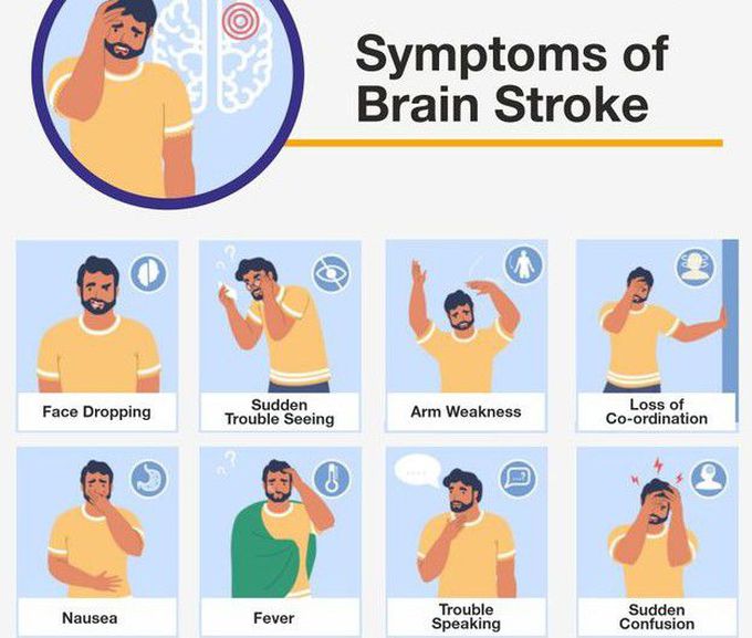 Symptoms of Embolic stroke