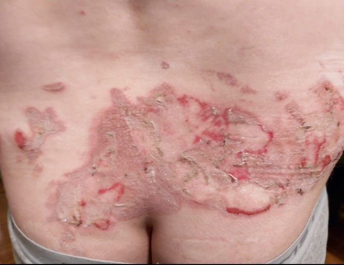 2nd degree burn