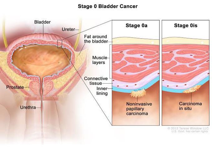 Bladder cancer