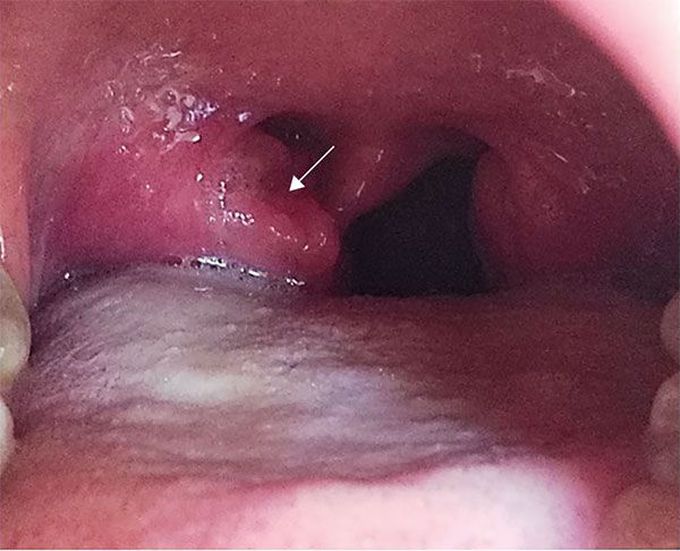 What is the most likely diagnosis?