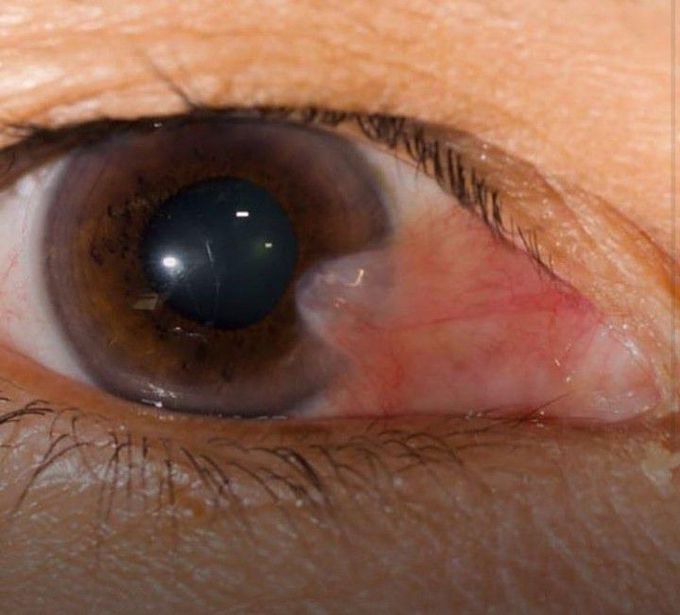 A pterygium is a growth of the conjunctiva or mucous membrane that covers the white part of your eye over the cornea. The cornea is the clear front covering of the eye. This benign or noncancerous growth is often shaped like a wedge.