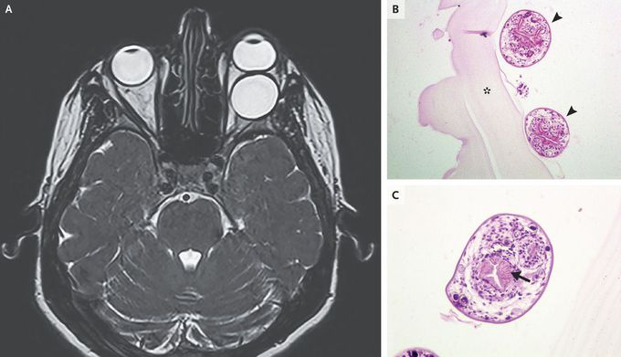 Orbital Hydatid Cyst