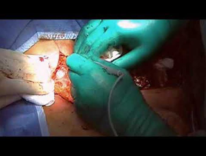Transmanubrial Approach for Resection of a Subclavicular Breast Cancer Recurrence