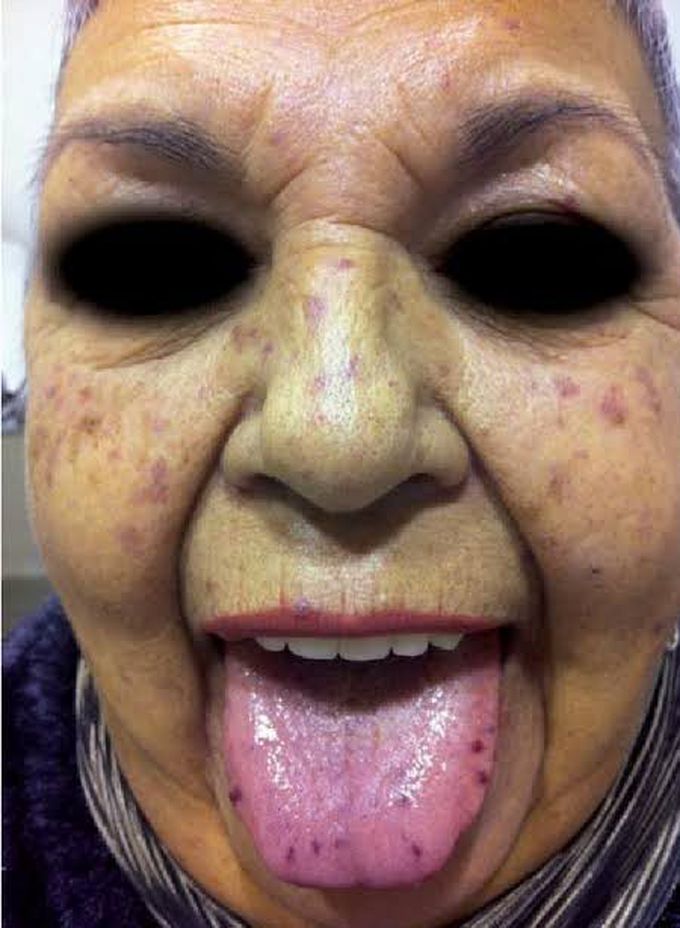 Osler weber rendu disease