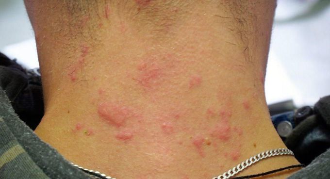 Symptoms of hives